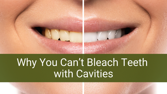 Why You Can’t Bleach Teeth with Cavities