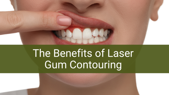 The Benefits of Laser Gum Contouring