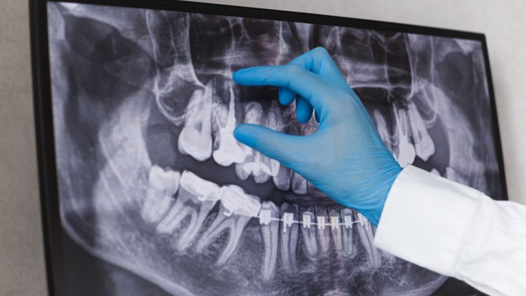 Dental X-ray with gloved hand pointing.