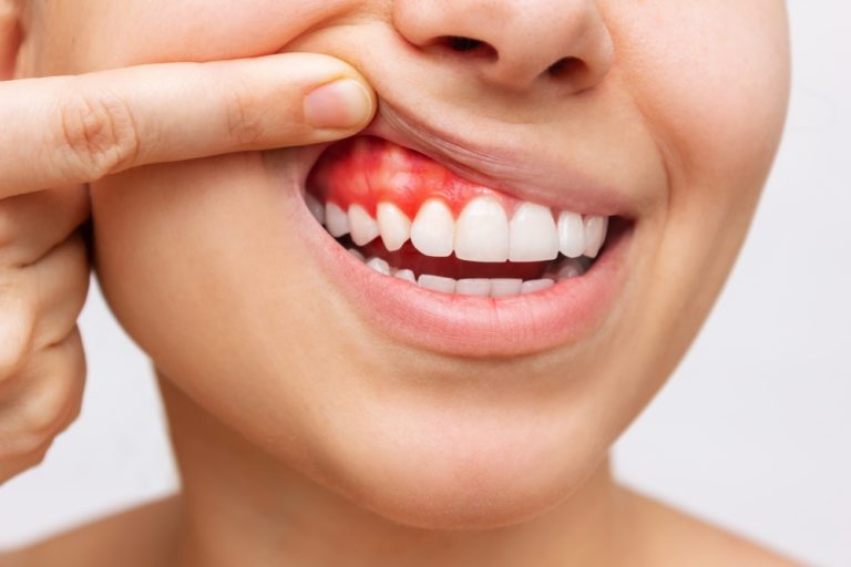 Person showing inflamed red gums and teeth.