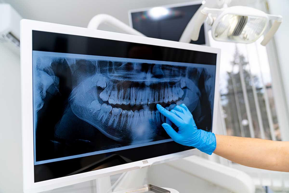Dentist in a blue glove pointing at a panoramic dental X-ray on a monitor