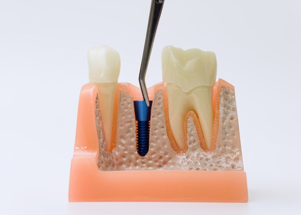Cross-section dental model showing a titanium implant post placed in the jaw bone between two natural teeth