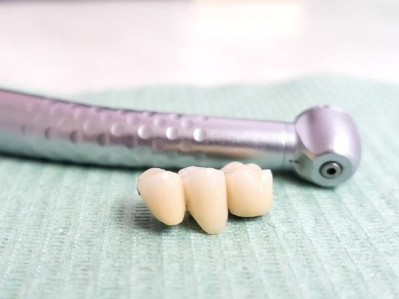 Meyerland-Family-Dentistry-Dental-Bridges-1-600x800